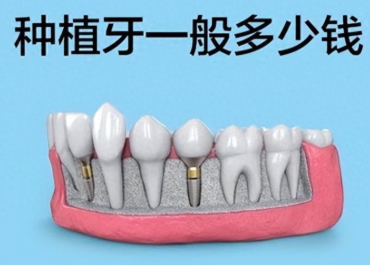 牙齒矯正為何需要支抗釘？費(fèi)用幾何？