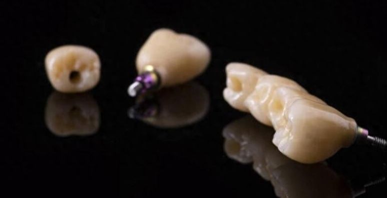 美奧口腔種植牙、牙齒矯正收費(fèi)貴不貴？價(jià)格表告訴您