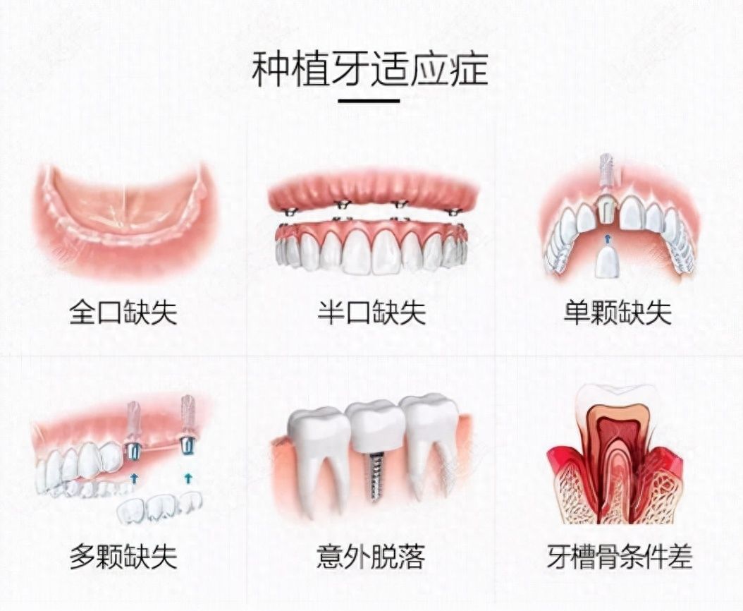 西安壹加壹牙齒矯正方案的費(fèi)用明細(xì)