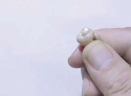 溫州醫(yī)科大學(xué)附屬口腔醫(yī)院種植牙專家案例價(jià)格查詢