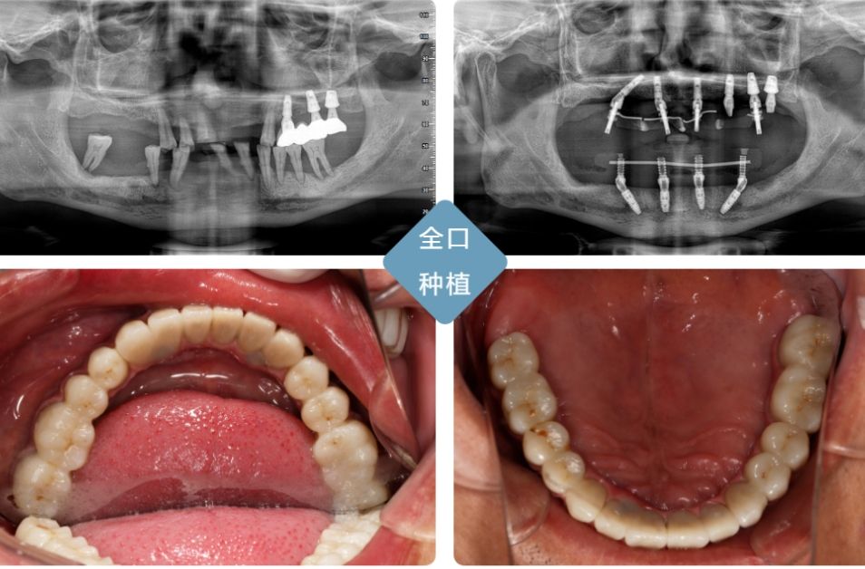 武俊杰口腔醫(yī)生網(wǎng)上掛號及種植牙費(fèi)用介紹