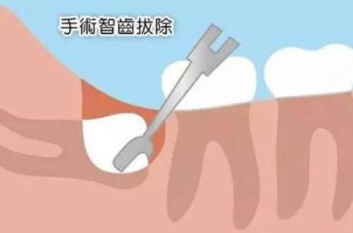 上海口腔整形醫(yī)生3D打印修復(fù)下頜角顴骨收費(fèi)標(biāo)準(zhǔn)